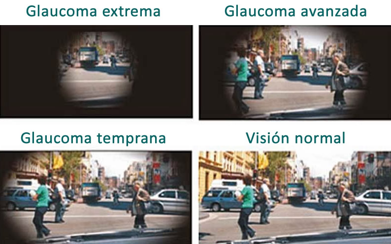glaucoma02