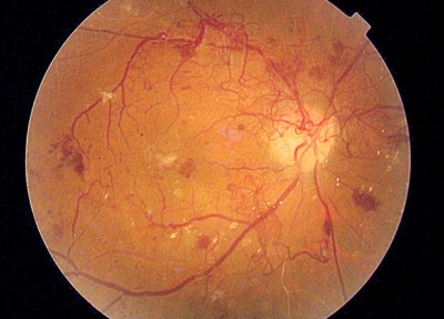 retinopatiadiabetica03